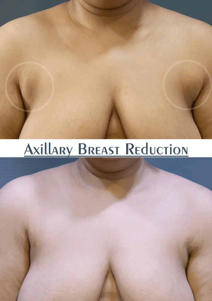 Breast Reduction surgery results showing natural-looking aesthetic refinement by Dr. Sumit Singh Gautam in Chandigarh