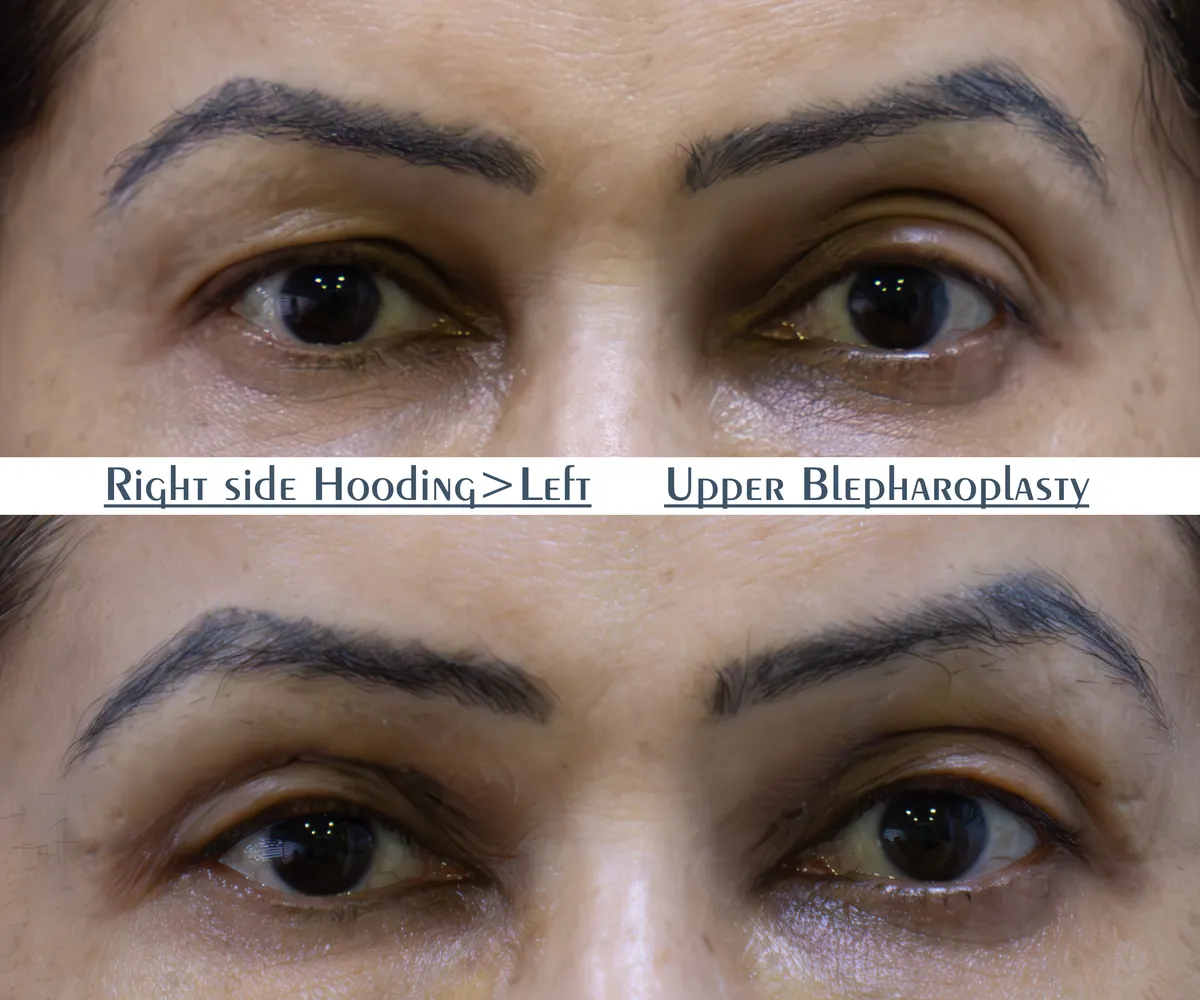 Blepharoplasty (Eye Bags) surgery results showing natural-looking aesthetic refinement by Dr. Sumit Singh Gautam in Chandigarh