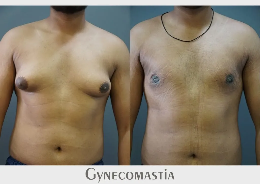 Gynecomastia (Male Breast Reduction) surgery results showing natural-looking aesthetic refinement by Dr. Sumit Singh Gautam in Chandigarh
