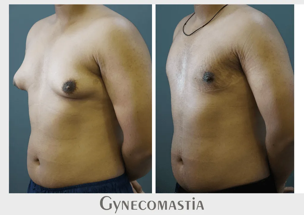 Gynecomastia (Male Breast Reduction) surgery results showing natural-looking aesthetic refinement by Dr. Sumit Singh Gautam in Chandigarh