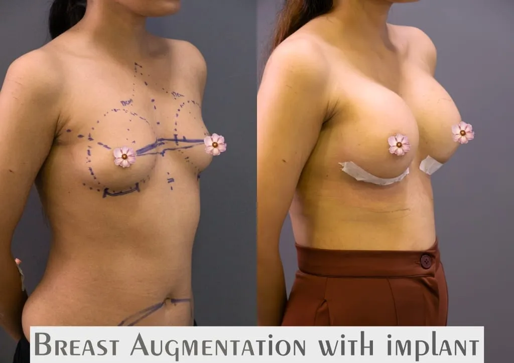 Breast Augmentation surgery results showing natural-looking aesthetic refinement by Dr. Sumit Singh Gautam in Chandigarh