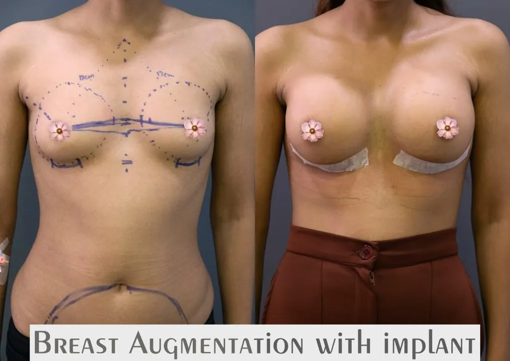 Breast Augmentation surgery results showing natural-looking aesthetic refinement by Dr. Sumit Singh Gautam in Chandigarh