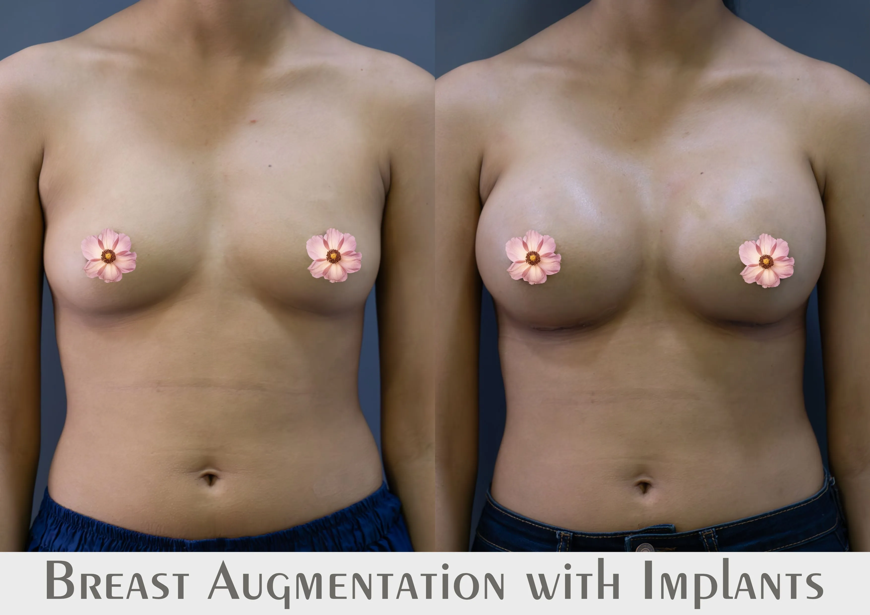 Breast Augmentation surgery results showing natural-looking aesthetic refinement by Dr. Sumit Singh Gautam in Chandigarh