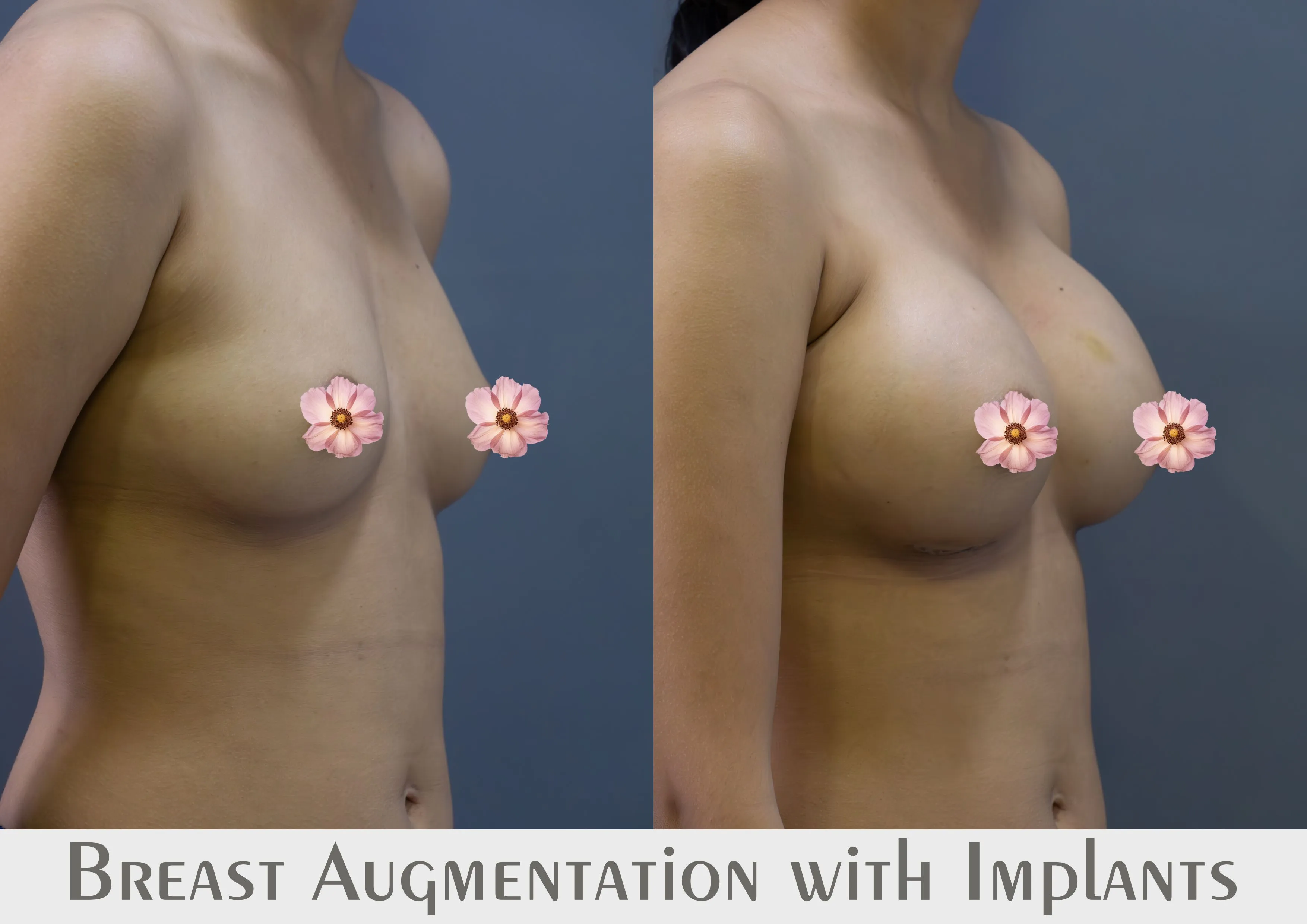 Breast Augmentation surgery results showing natural-looking aesthetic refinement by Dr. Sumit Singh Gautam in Chandigarh