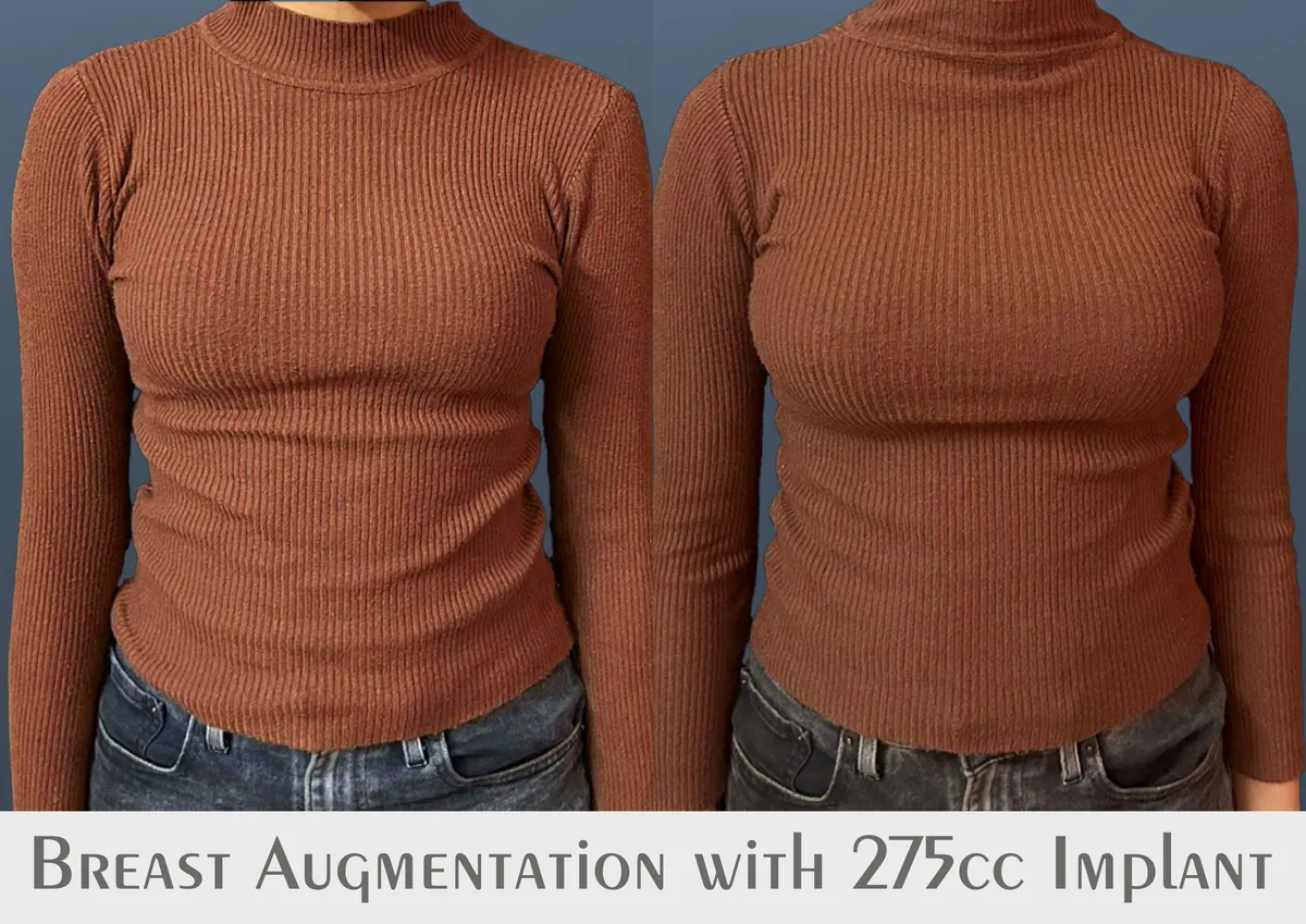 Breast Augmentation surgery results showing natural-looking aesthetic refinement by Dr. Sumit Singh Gautam in Chandigarh