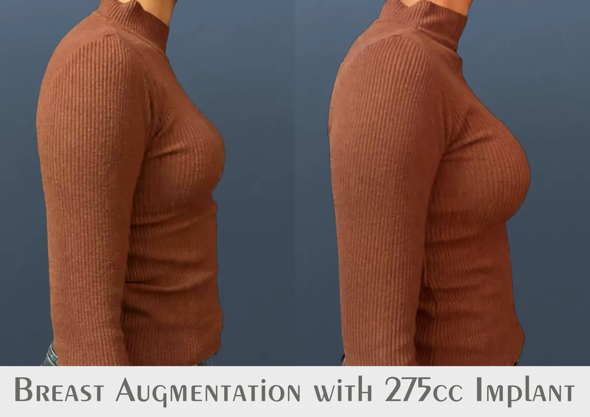 Breast Augmentation surgery results showing natural-looking aesthetic refinement by Dr. Sumit Singh Gautam in Chandigarh
