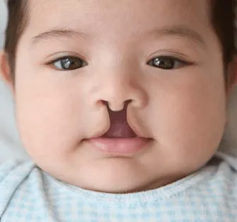 Cleft Lip & Palate Repair