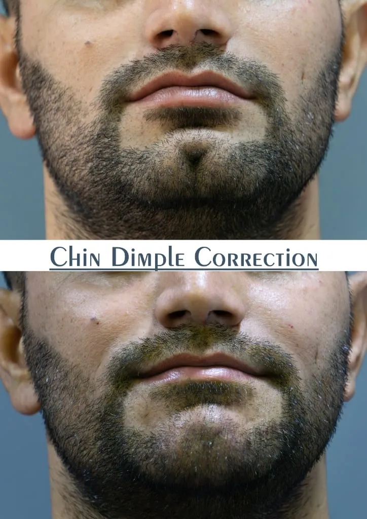 Fat Grafting surgery results showing natural-looking aesthetic refinement by Dr. Sumit Singh Gautam in Chandigarh