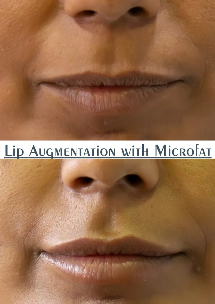 Fat Grafting surgery results showing natural-looking aesthetic refinement by Dr. Sumit Singh Gautam in Chandigarh