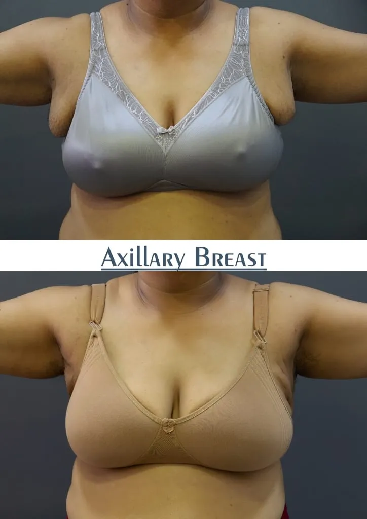 Axillary Breast outcome by Dr. Sumit Singh Gautam in Chandigarh