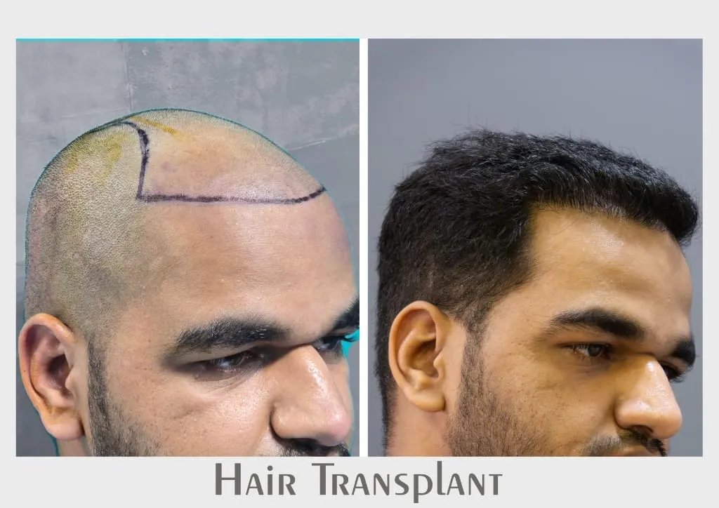 Hair Transplant outcome by Dr. Sumit Singh Gautam in Chandigarh