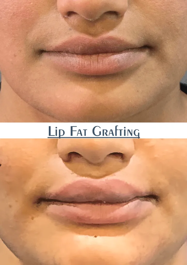 Lip Fat Grafting outcome by Dr. Sumit Singh Gautam in Chandigarh