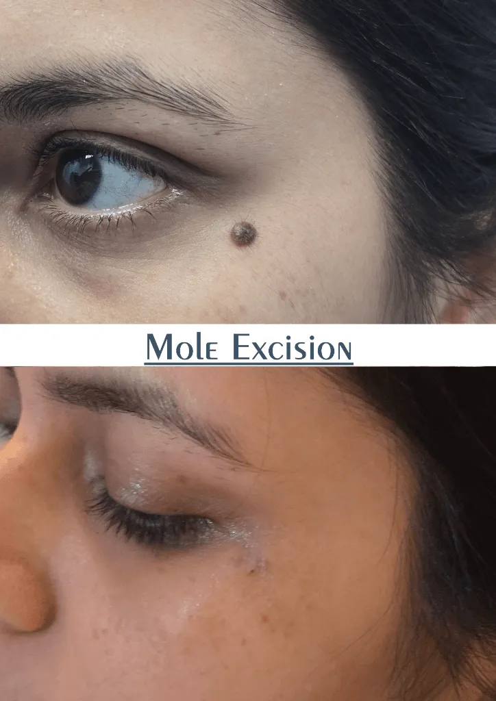 Mole Excision outcome by Dr. Sumit Singh Gautam in Chandigarh