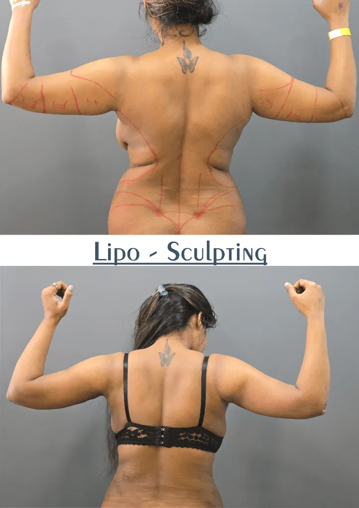 Lipo-Sculpting outcome by Dr. Sumit Singh Gautam in Chandigarh