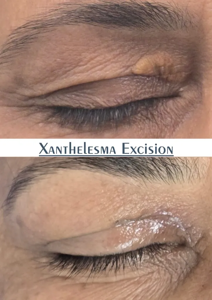 Xanthelasma Excision outcome by Dr. Sumit Singh Gautam in Chandigarh
