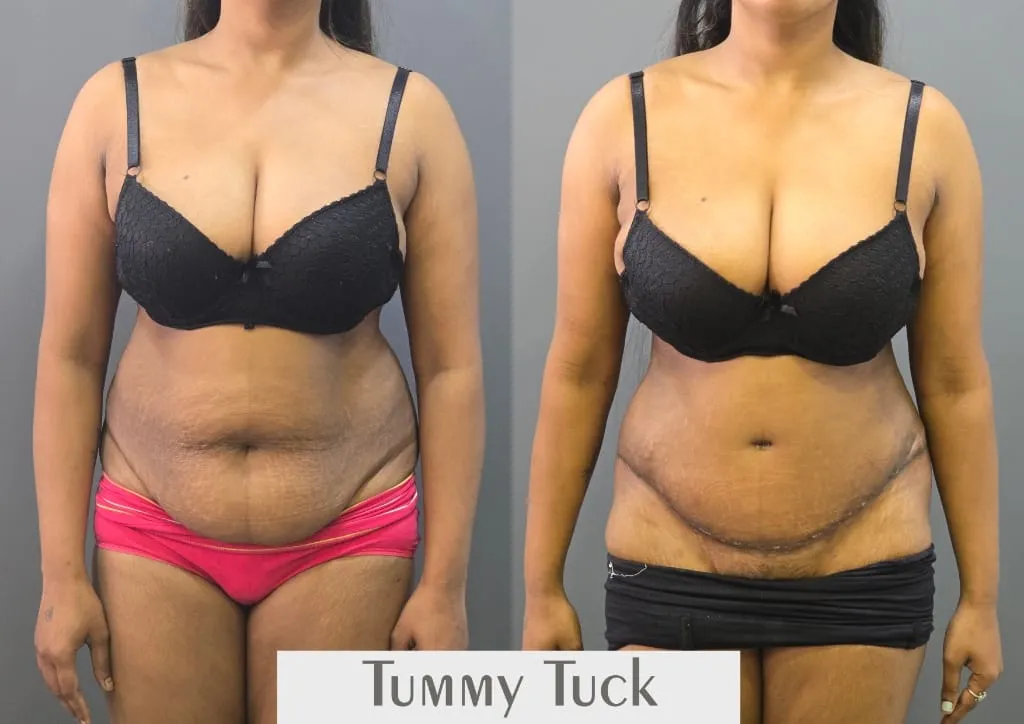 Tummy Tuck outcome by Dr. Sumit Singh Gautam in Chandigarh
