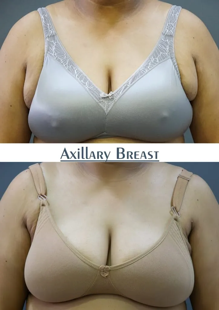 Axillary Breast outcome by Dr. Sumit Singh Gautam in Chandigarh