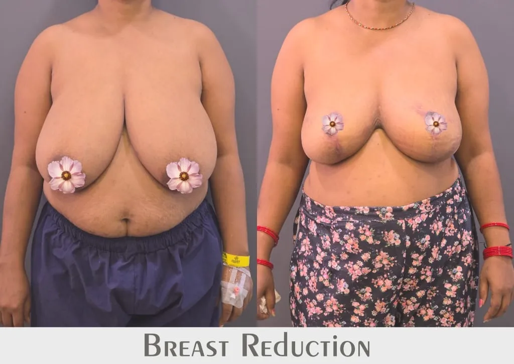 Breast Reduction outcome by Dr. Sumit Singh Gautam in Chandigarh