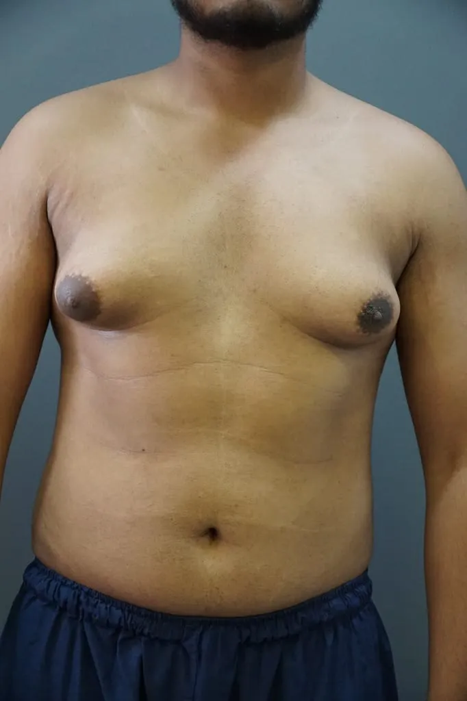 Gynecomastia (Male Breast Reduction)