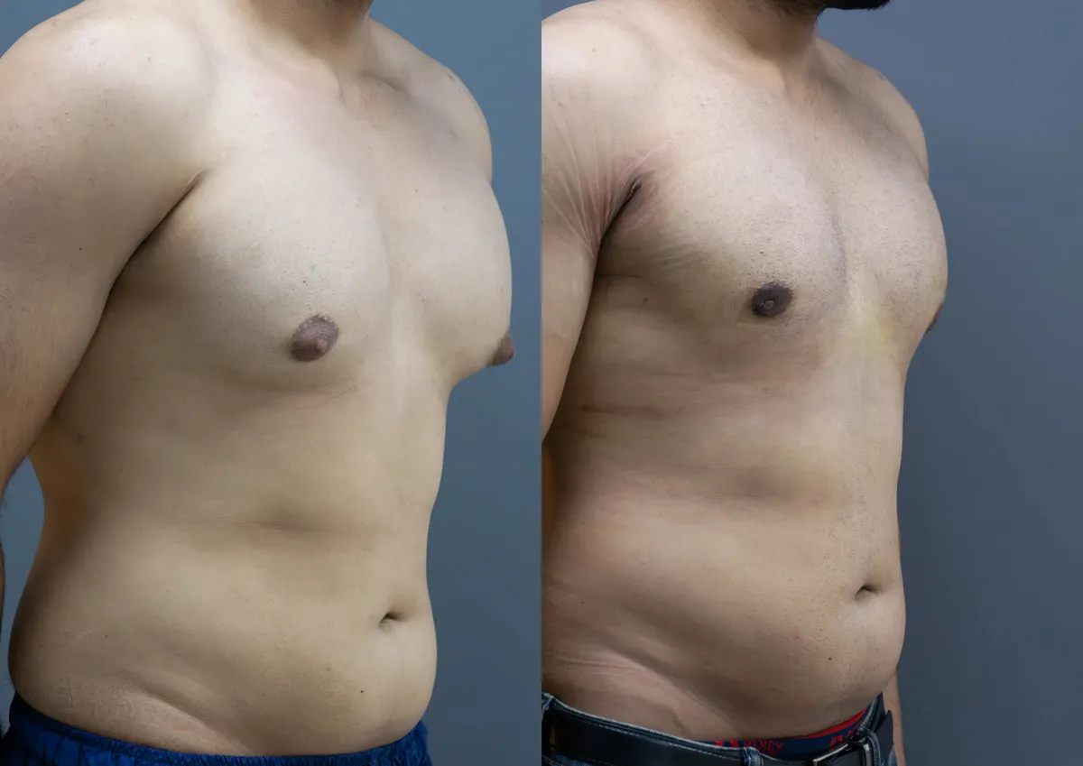 Gynecomastia (Male Breast Reduction) surgery results showing natural-looking aesthetic refinement by Dr. Sumit Singh Gautam in Chandigarh