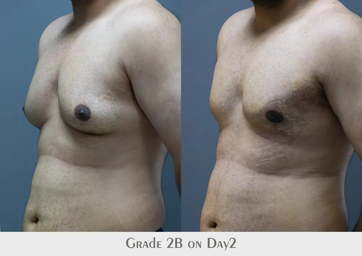 Gynecomastia (Male Breast Reduction) surgery results showing natural-looking aesthetic refinement by Dr. Sumit Singh Gautam in Chandigarh
