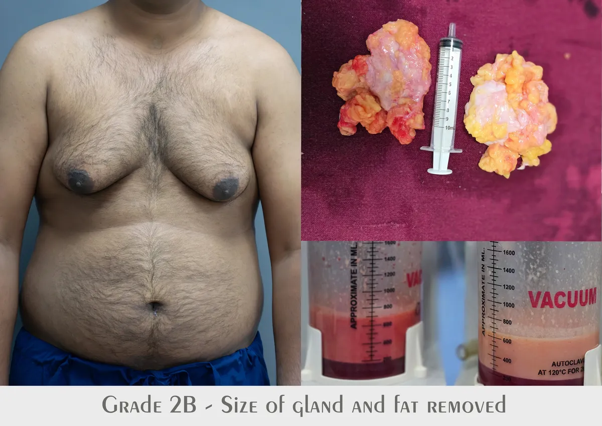 Gynecomastia (Male Breast Reduction) surgery results showing natural-looking aesthetic refinement by Dr. Sumit Singh Gautam in Chandigarh