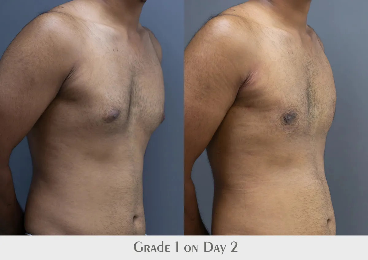 Gynecomastia (Male Breast Reduction) surgery results showing natural-looking aesthetic refinement by Dr. Sumit Singh Gautam in Chandigarh
