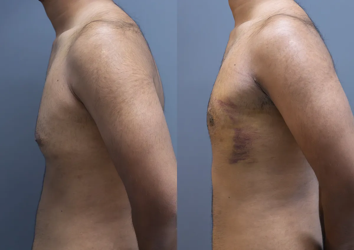 Gynecomastia (Male Breast Reduction) surgery results showing natural-looking aesthetic refinement by Dr. Sumit Singh Gautam in Chandigarh