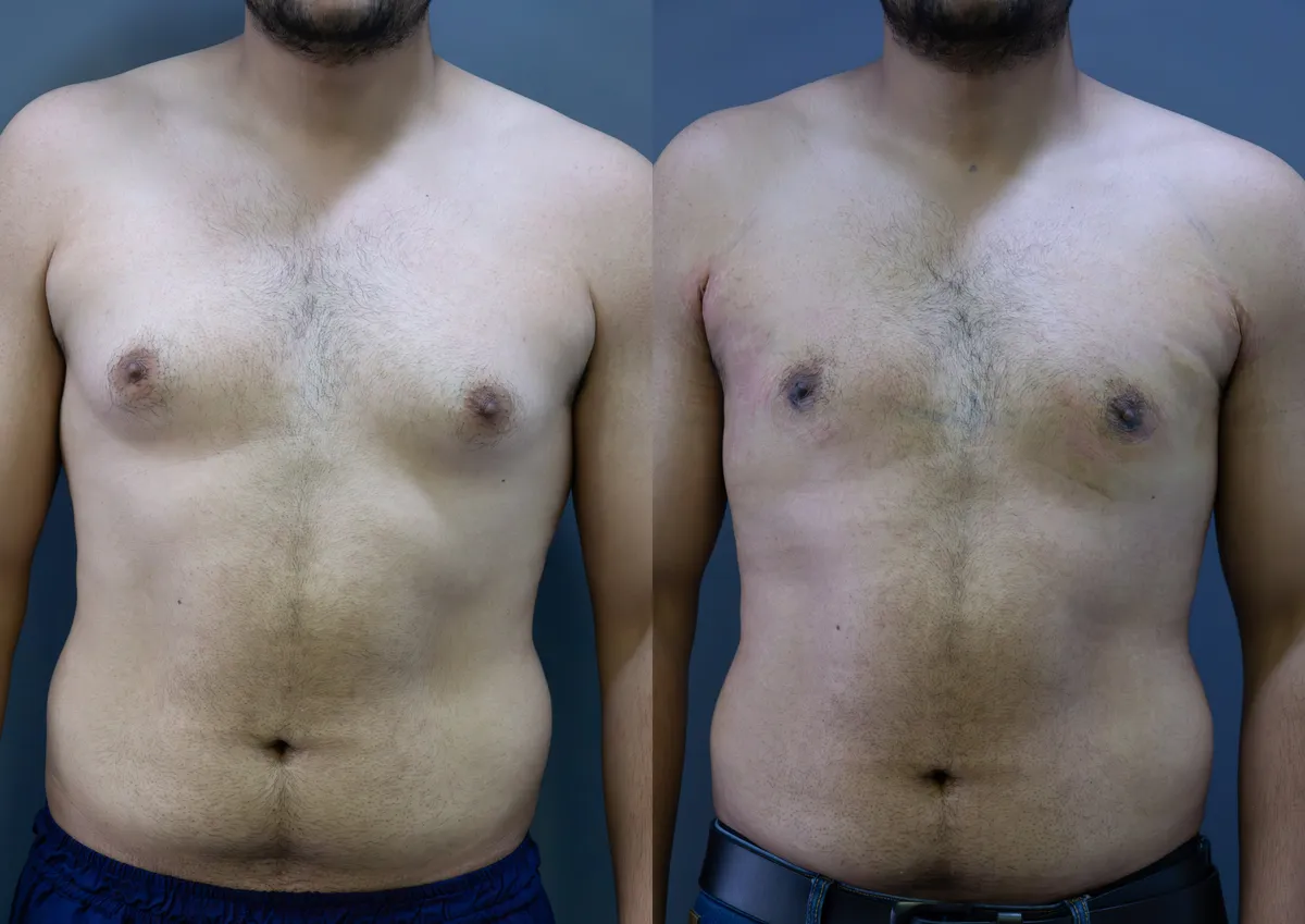Gynecomastia (Male Breast Reduction) surgery results showing natural-looking aesthetic refinement by Dr. Sumit Singh Gautam in Chandigarh