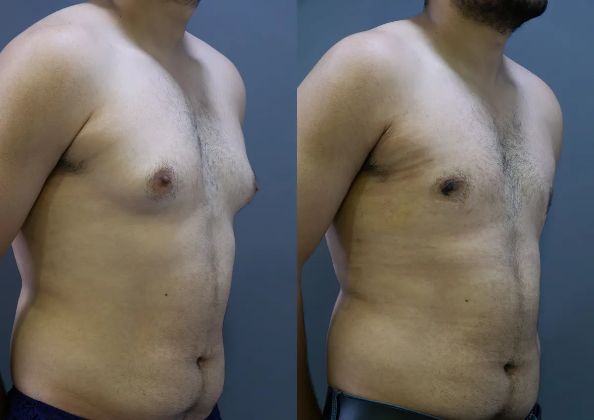 Gynecomastia (Male Breast Reduction) surgery results showing natural-looking aesthetic refinement by Dr. Sumit Singh Gautam in Chandigarh