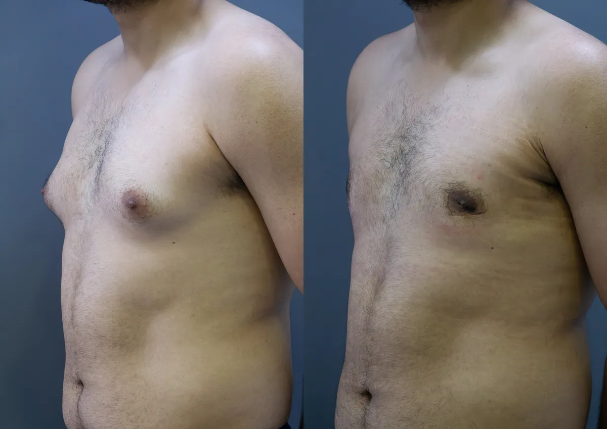 Gynecomastia (Male Breast Reduction) surgery results showing natural-looking aesthetic refinement by Dr. Sumit Singh Gautam in Chandigarh