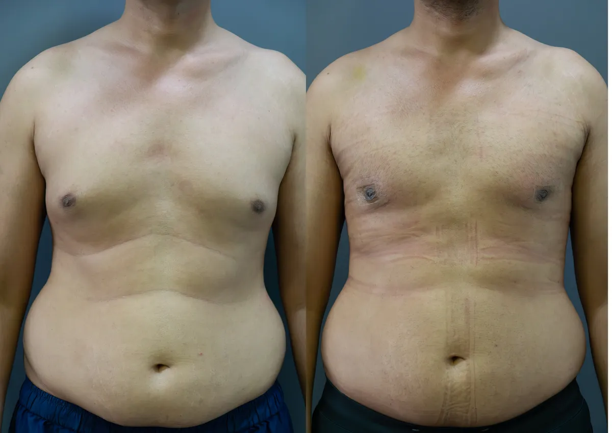Gynecomastia (Male Breast Reduction) surgery results showing natural-looking aesthetic refinement by Dr. Sumit Singh Gautam in Chandigarh