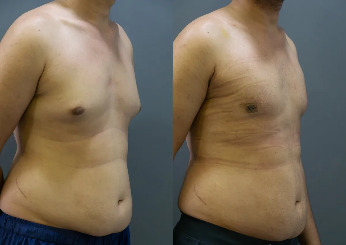 Gynecomastia (Male Breast Reduction) surgery results showing natural-looking aesthetic refinement by Dr. Sumit Singh Gautam in Chandigarh