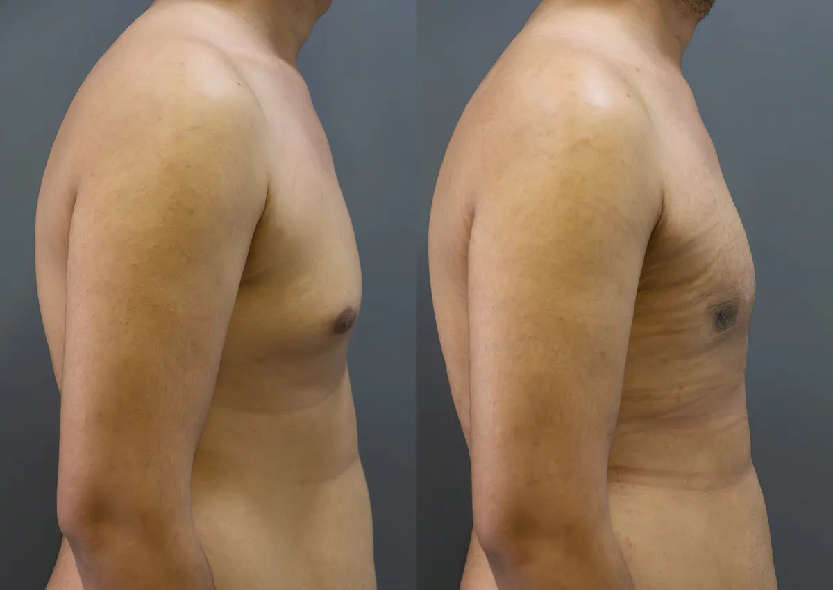 Gynecomastia (Male Breast Reduction) surgery results showing natural-looking aesthetic refinement by Dr. Sumit Singh Gautam in Chandigarh