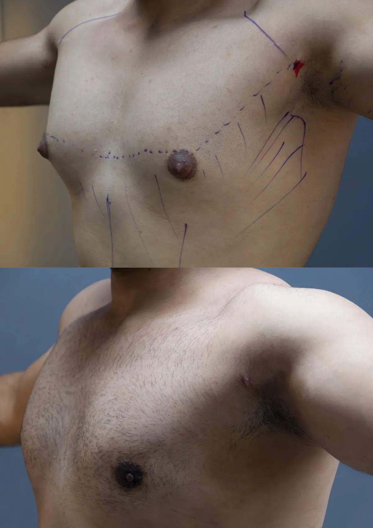 Gynecomastia (Male Breast Reduction) surgery results showing natural-looking aesthetic refinement by Dr. Sumit Singh Gautam in Chandigarh