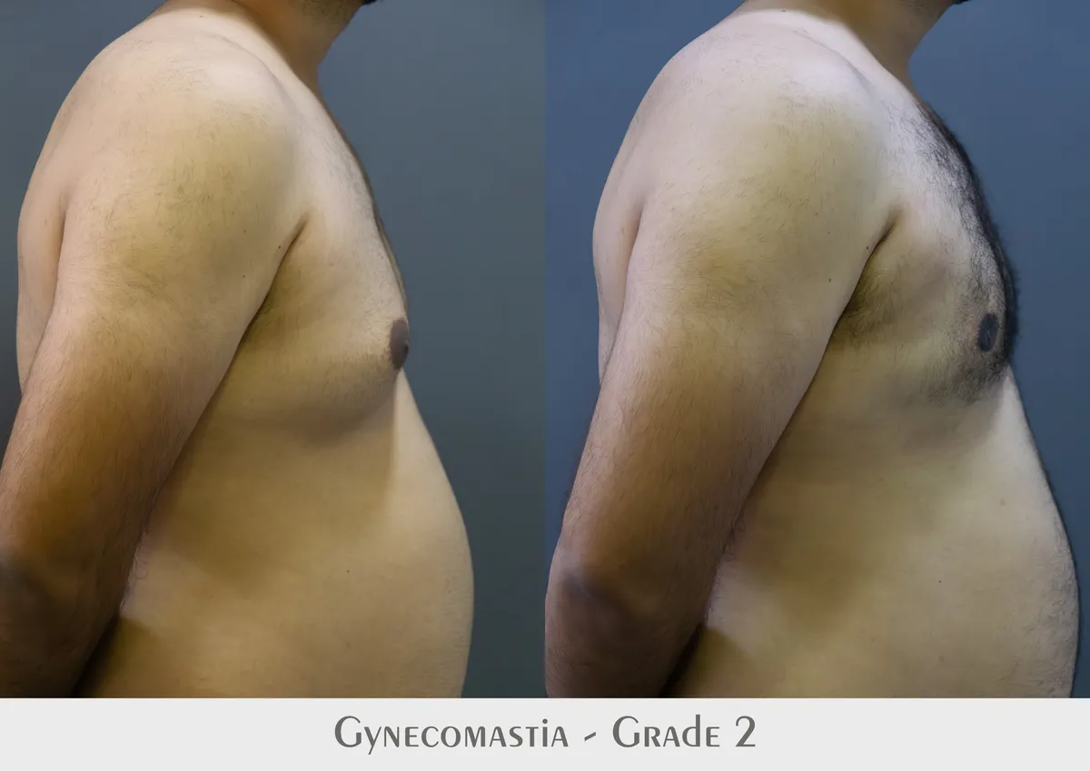 Gynecomastia (Male Breast Reduction) surgery results showing natural-looking aesthetic refinement by Dr. Sumit Singh Gautam in Chandigarh