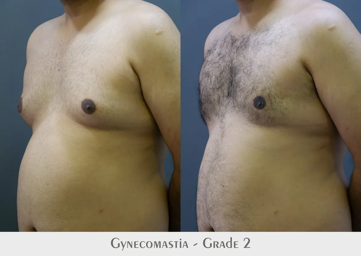 Gynecomastia (Male Breast Reduction) surgery results showing natural-looking aesthetic refinement by Dr. Sumit Singh Gautam in Chandigarh