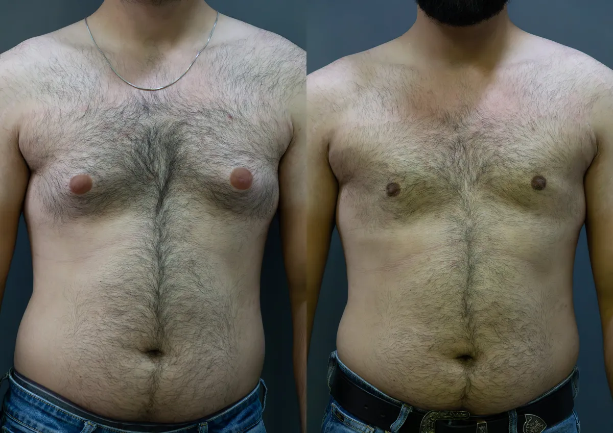 Gynecomastia (Male Breast Reduction) surgery results showing natural-looking aesthetic refinement by Dr. Sumit Singh Gautam in Chandigarh