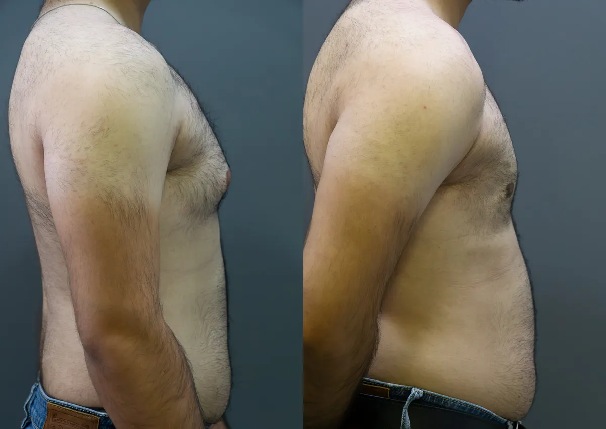 Gynecomastia (Male Breast Reduction) surgery results showing natural-looking aesthetic refinement by Dr. Sumit Singh Gautam in Chandigarh