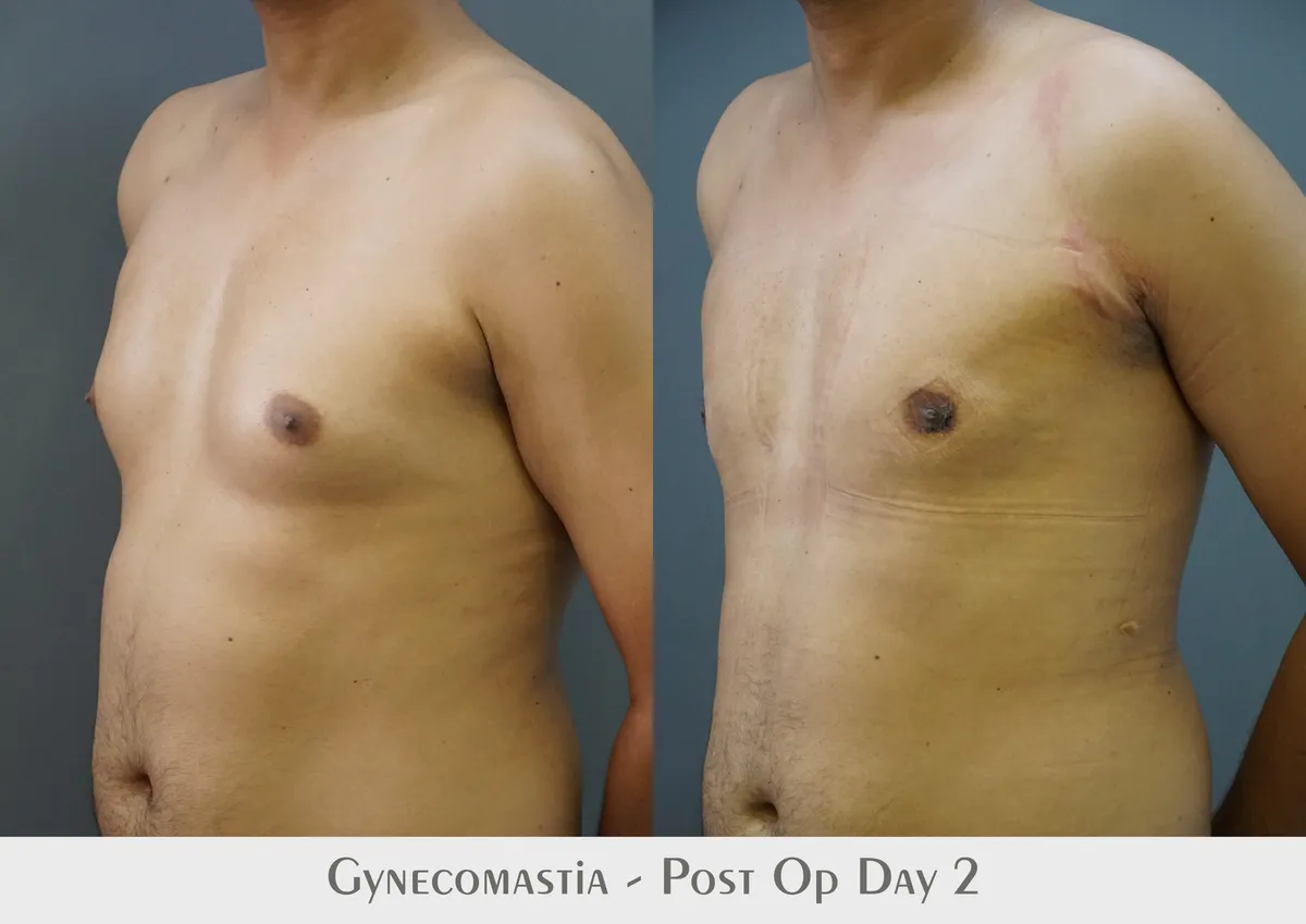 Gynecomastia (Male Breast Reduction) surgery results showing natural-looking aesthetic refinement by Dr. Sumit Singh Gautam in Chandigarh
