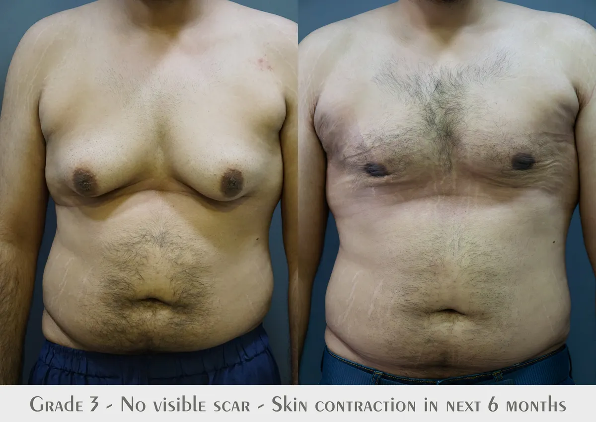 Gynecomastia (Male Breast Reduction) surgery results showing natural-looking aesthetic refinement by Dr. Sumit Singh Gautam in Chandigarh
