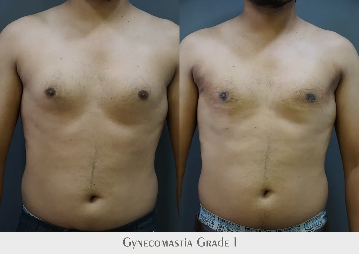 Gynecomastia (Male Breast Reduction) surgery results showing natural-looking aesthetic refinement by Dr. Sumit Singh Gautam in Chandigarh