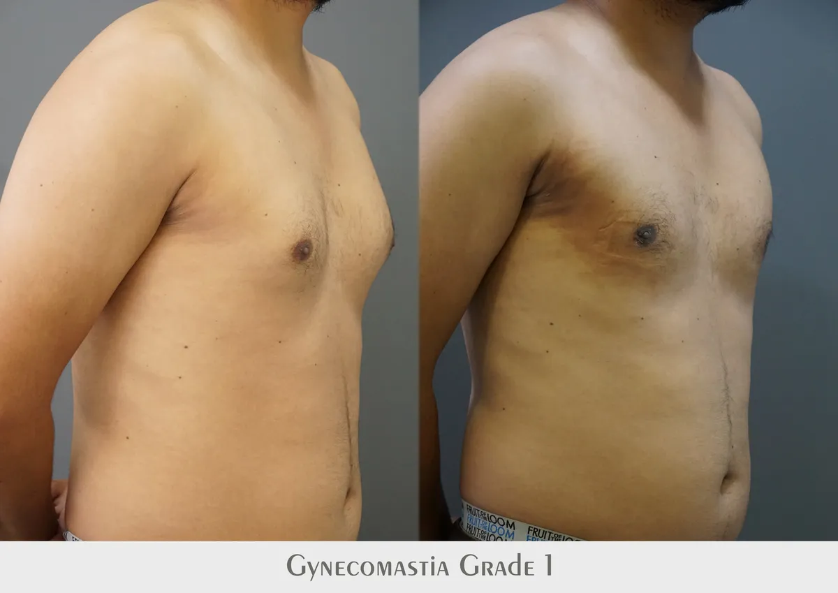 Gynecomastia (Male Breast Reduction) surgery results showing natural-looking aesthetic refinement by Dr. Sumit Singh Gautam in Chandigarh