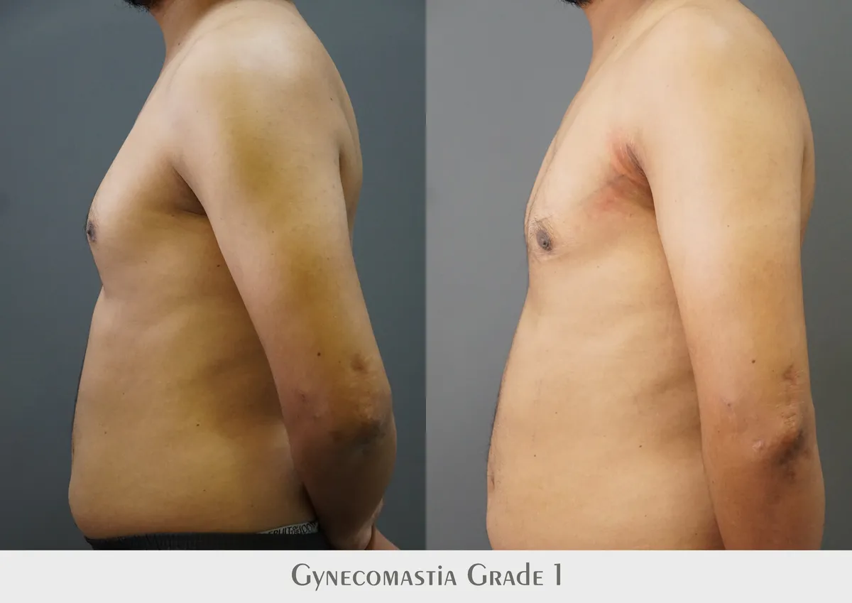 Gynecomastia (Male Breast Reduction) surgery results showing natural-looking aesthetic refinement by Dr. Sumit Singh Gautam in Chandigarh