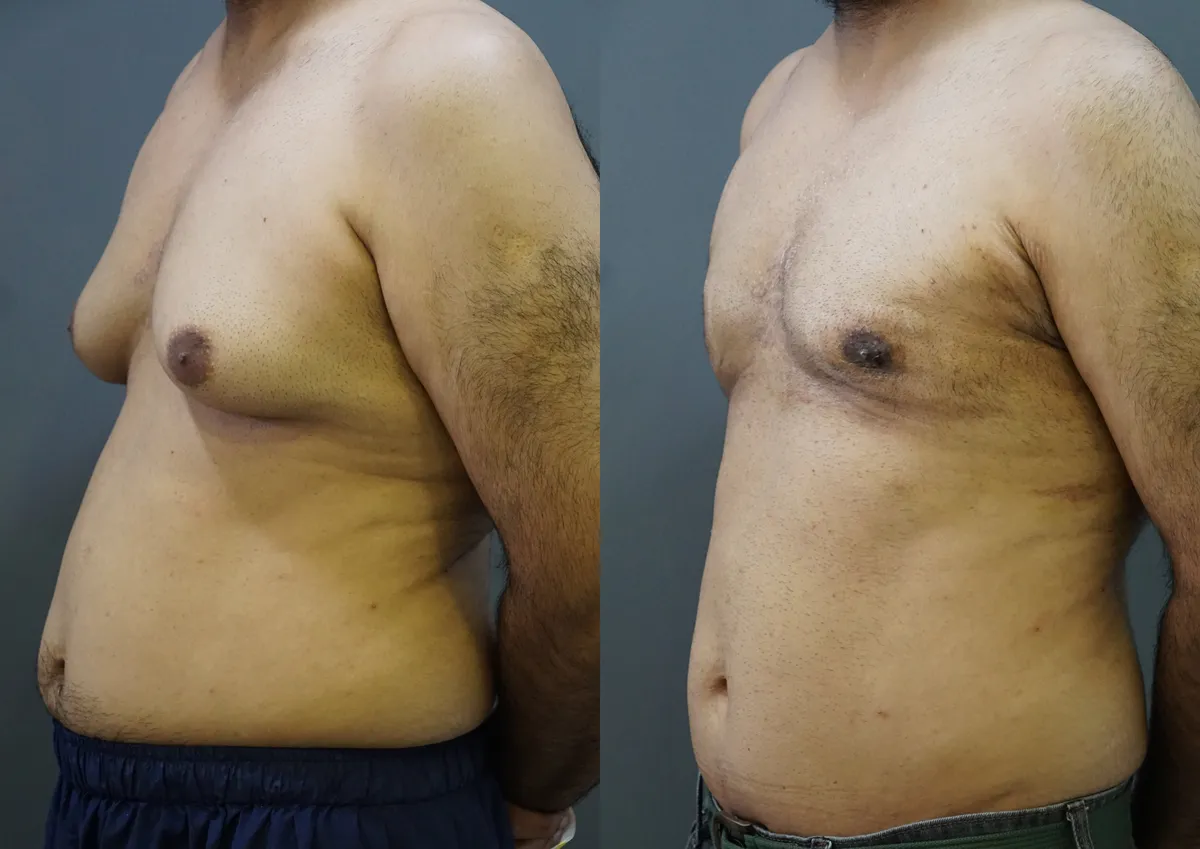 Gynecomastia (Male Breast Reduction) surgery results showing natural-looking aesthetic refinement by Dr. Sumit Singh Gautam in Chandigarh