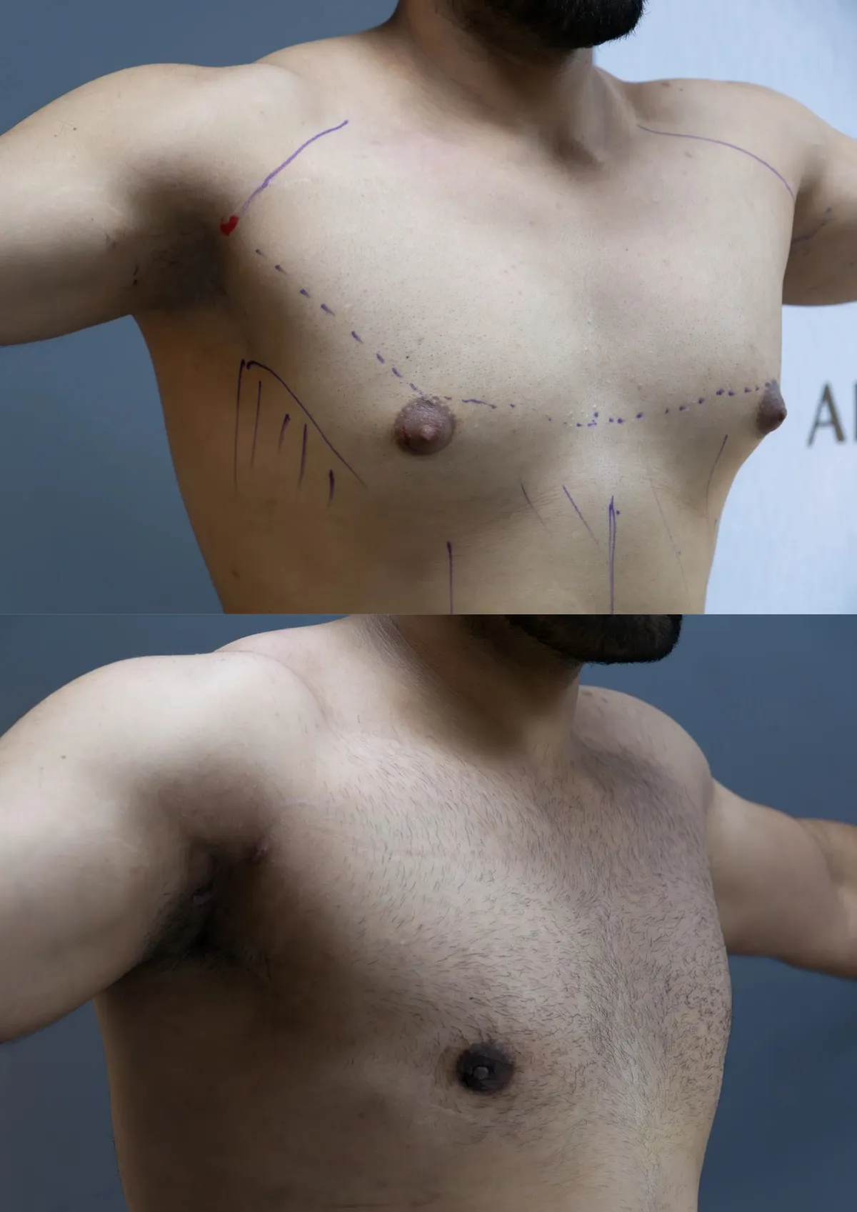 Gynecomastia (Male Breast Reduction) surgery results showing natural-looking aesthetic refinement by Dr. Sumit Singh Gautam in Chandigarh