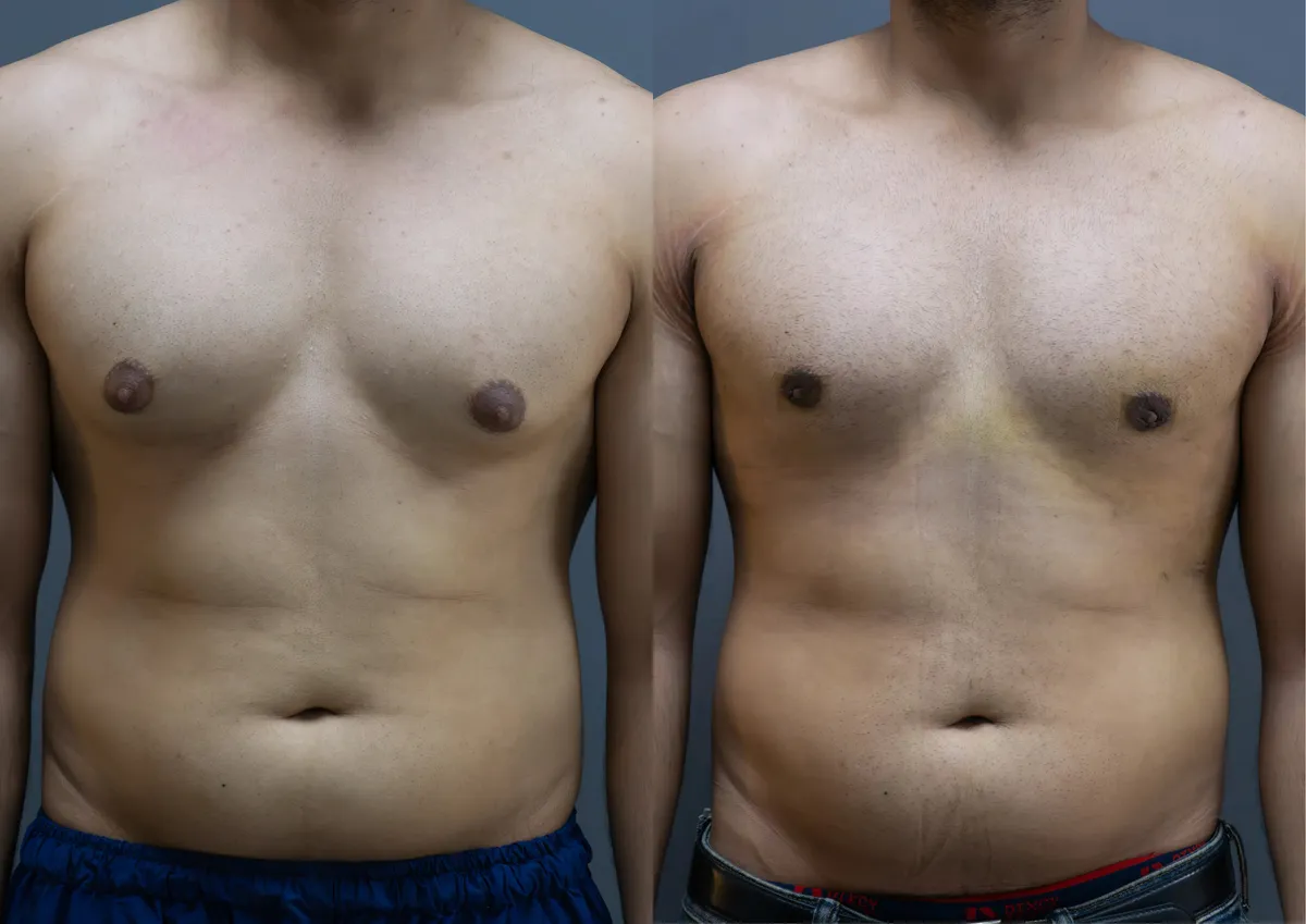 Gynecomastia (Male Breast Reduction) surgery results showing natural-looking aesthetic refinement by Dr. Sumit Singh Gautam in Chandigarh
