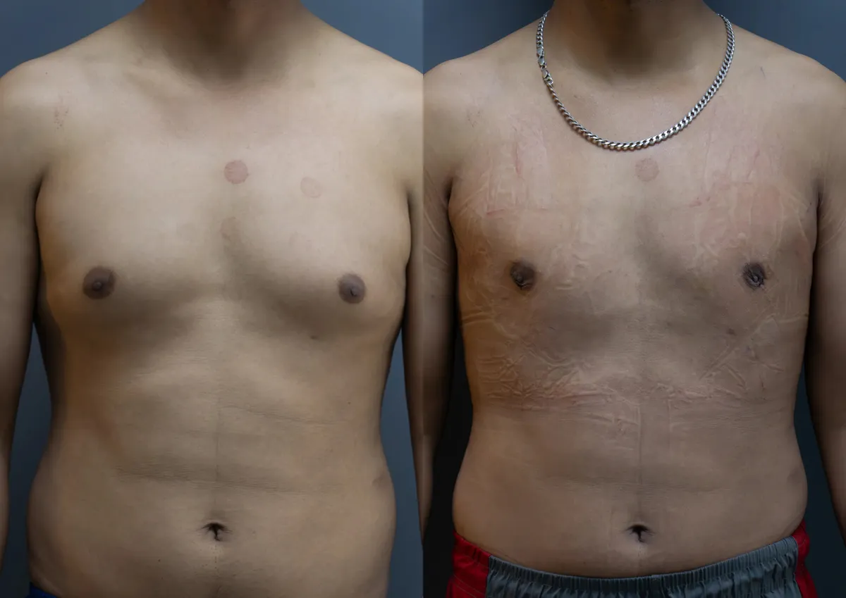 Gynecomastia (Male Breast Reduction) surgery results showing natural-looking aesthetic refinement by Dr. Sumit Singh Gautam in Chandigarh