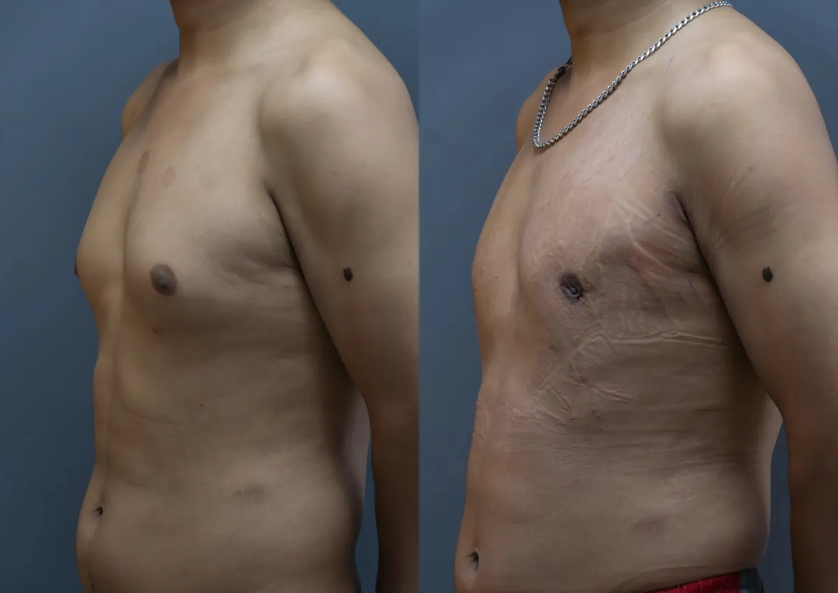 Gynecomastia (Male Breast Reduction) surgery results showing natural-looking aesthetic refinement by Dr. Sumit Singh Gautam in Chandigarh