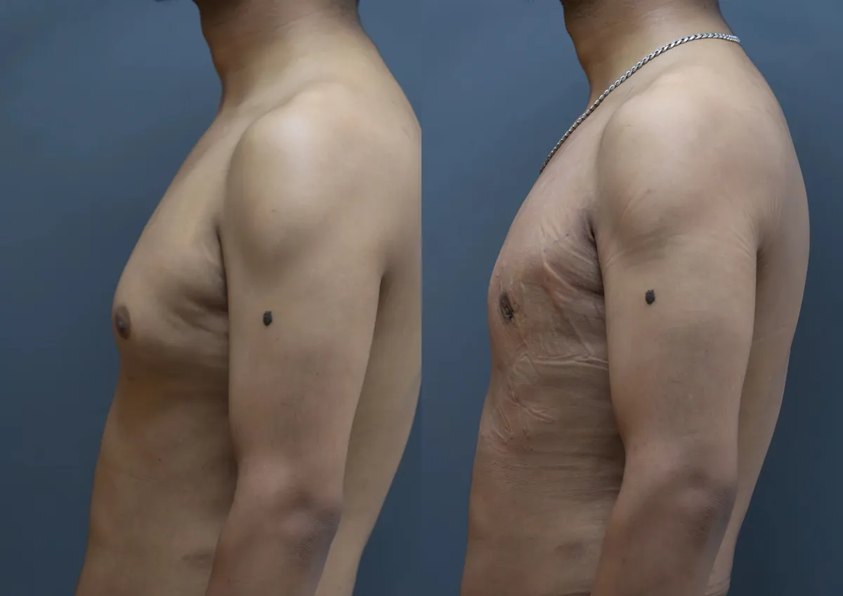 Gynecomastia (Male Breast Reduction) surgery results showing natural-looking aesthetic refinement by Dr. Sumit Singh Gautam in Chandigarh